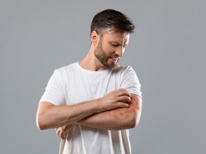 ما أعراض الحكة العقيدية؟