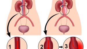 تطوير أدوية تقي من أخطار تمزق الأوعية الدموية