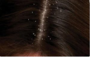 هل يمكن أن تختفي قشرة الشعر نهائيًا؟.. استشارية توضح