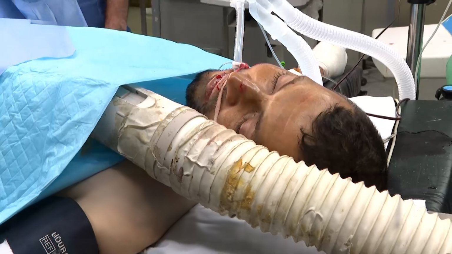 أول تعليق لمراسل الجزيرة إسماعيل أبو عمر بعد بتر قدمه: صواريخ الاحتلال لن تخيفنا