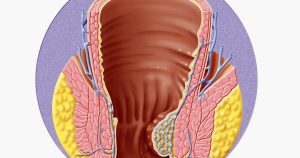 6 عوامل ترفع خطر تضخم البواسير