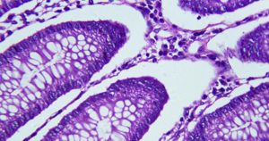 باحثون صينيون يحرزون تقدما هاما في علاج سرطان القولون