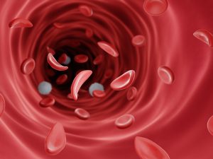 هكذا يغير العلاج الجيني حياة مرضى عانوا المر بسبب فقر الدم المنجلي