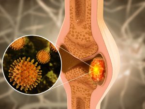 أعراض سرطان ساركوما