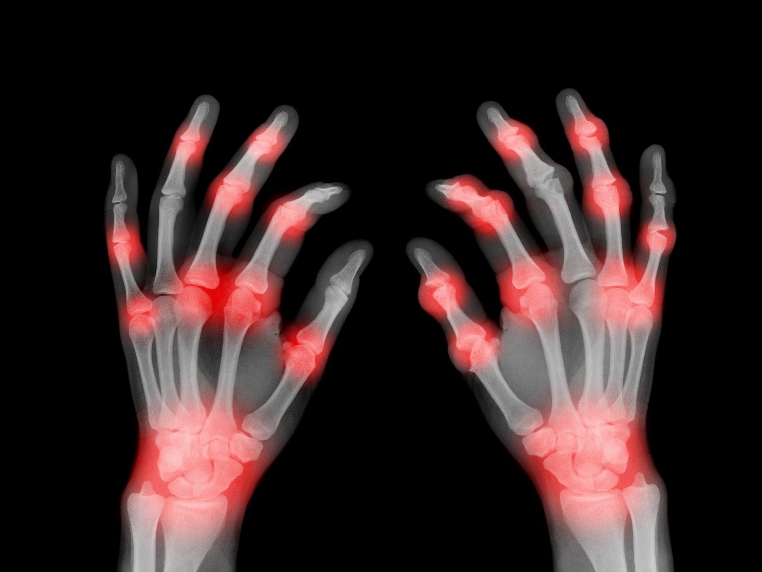 ما متلازمة الألم الناحي المركب؟