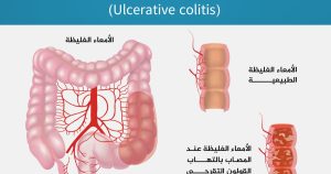 ألم المستقيم.. الأسباب والعلاج