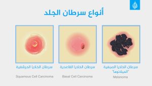 هل يؤدي واقي الشمس إلى نقص فيتامين دي؟ وهل ضوء الشمس من النافذة مفيد؟