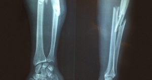 كسور الأطفال في العيد.. كيف نتعامل معها؟