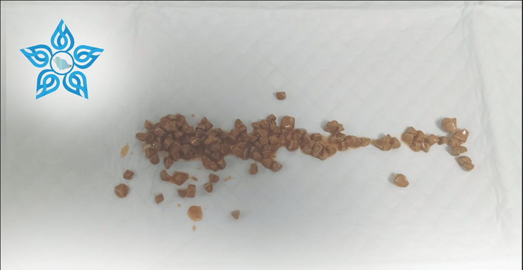 استخراج 140 حصوة من القناة المرارية لثلاثيني بمنظار متطور في مستشفى ينبع العام