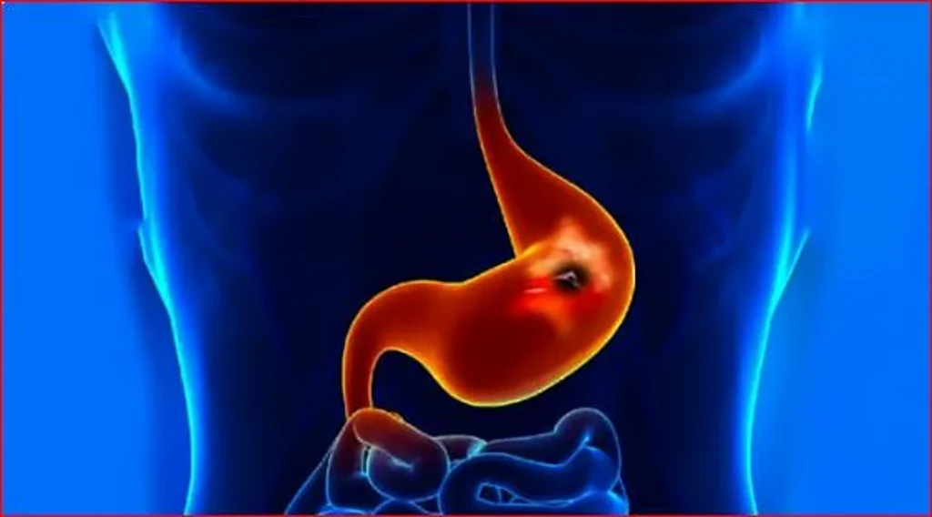 استشاري: 7 حالات لعمل فحص جرثومة المعدة