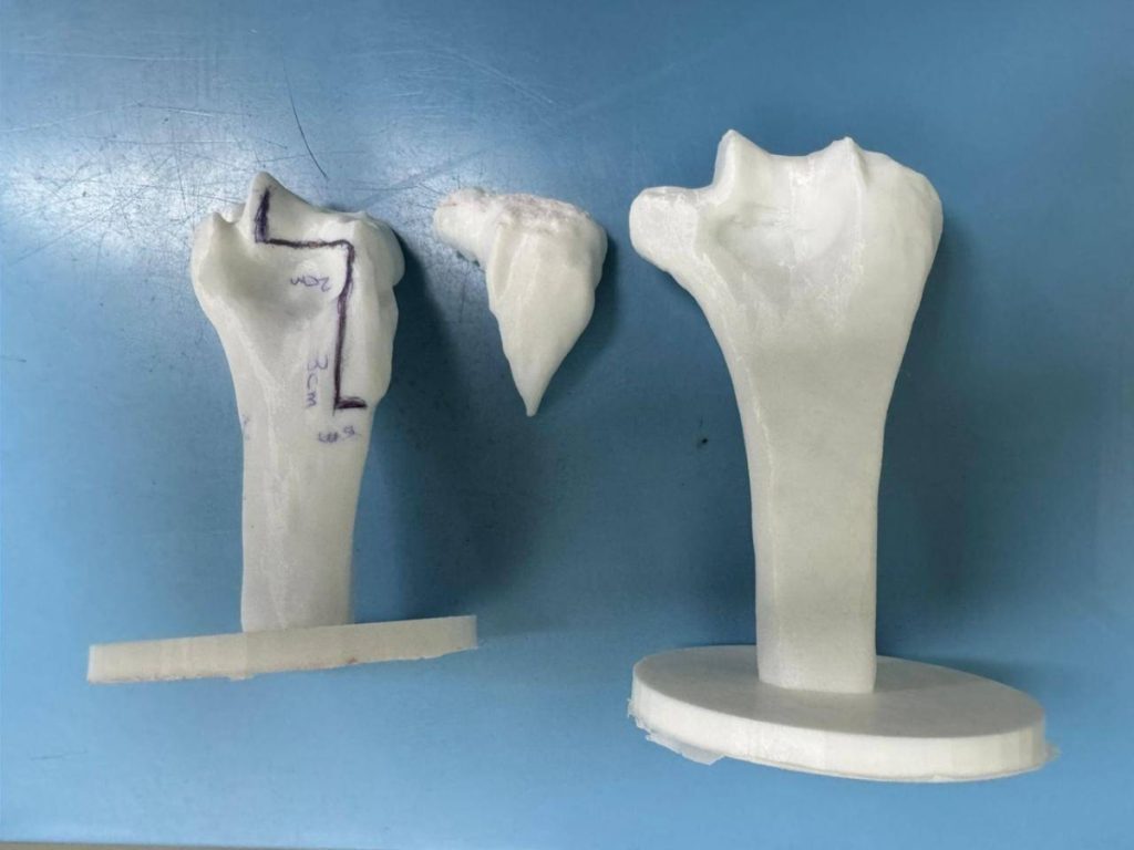 مستشفى الملك فهد الجامعي يحقق إنجازاً نوعياً بزراعة عظم ومفصل المرفق وترميم الأربطة المحيطة