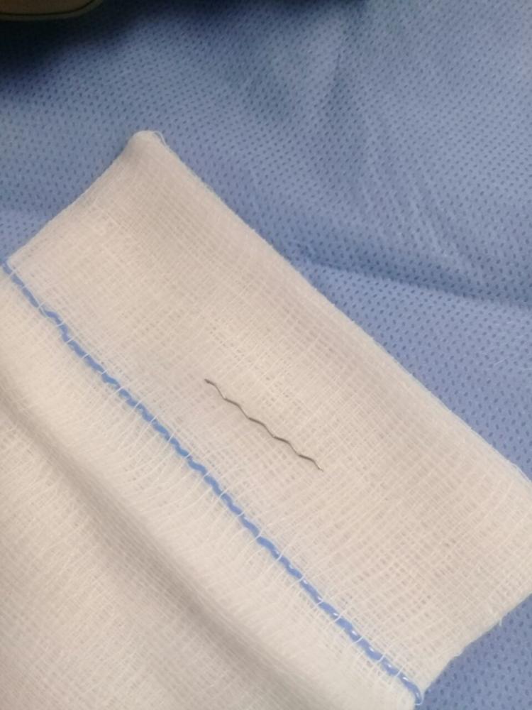 فريق طبي يستخرج "إبرة" من مريء سيدة في القريات