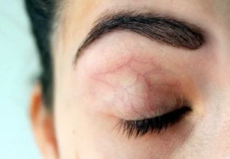 جفون صافية بلا عروق ظاهرة