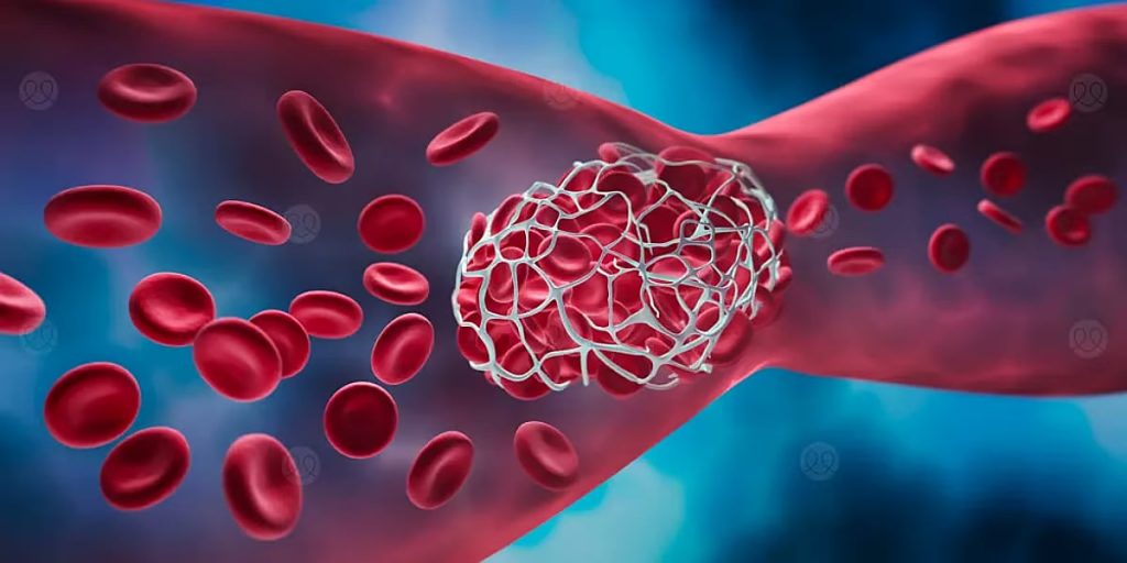 فهد الطبية توضح الأعراض المصاحبة للجلطات الدموية وطرق الوقاية منها