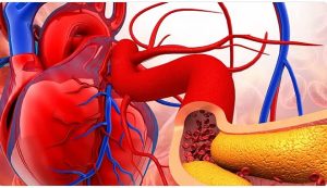 الخضيري يوضح أسباب تصلب الشرايين وطرق الوقاية