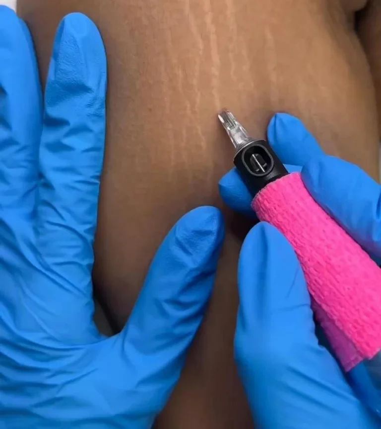 السترتش مارك: الأسباب، المراحل، وأحدث طرق العلاج – أخبار السعودية