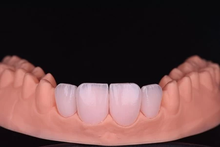 عدسات الأسنان بدون برد: المميزات والمخاطر بالتفصيل